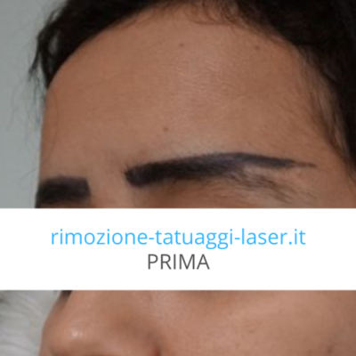 foto Tatuaggio sopracciglia rimosso prima