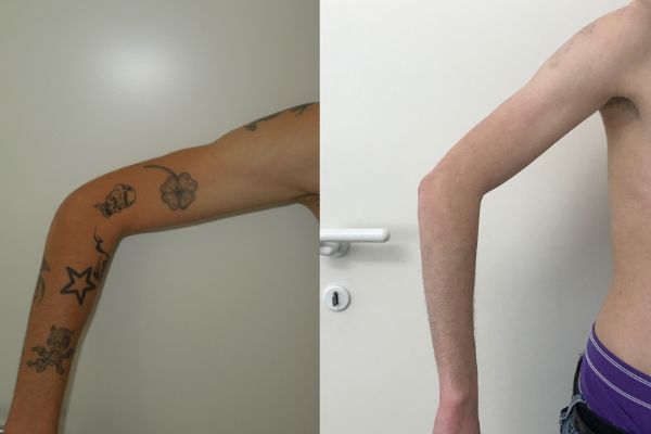 tatuaggio eliminato con laser foto prima e dopo
