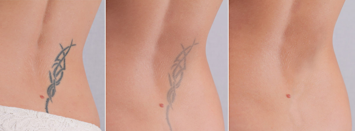 quanto costa rimuovere un tatuaggio