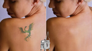 Qual è il miglior laser per la rimozione dei tatuaggi