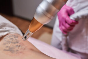 Quanto tempo occorre per rimuovere un tatuaggio