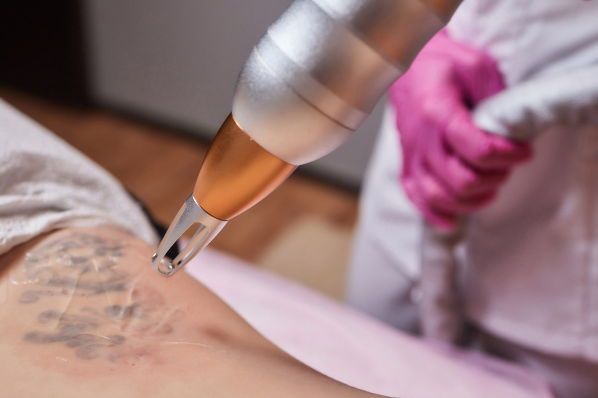 rimozione tatuaggi laser