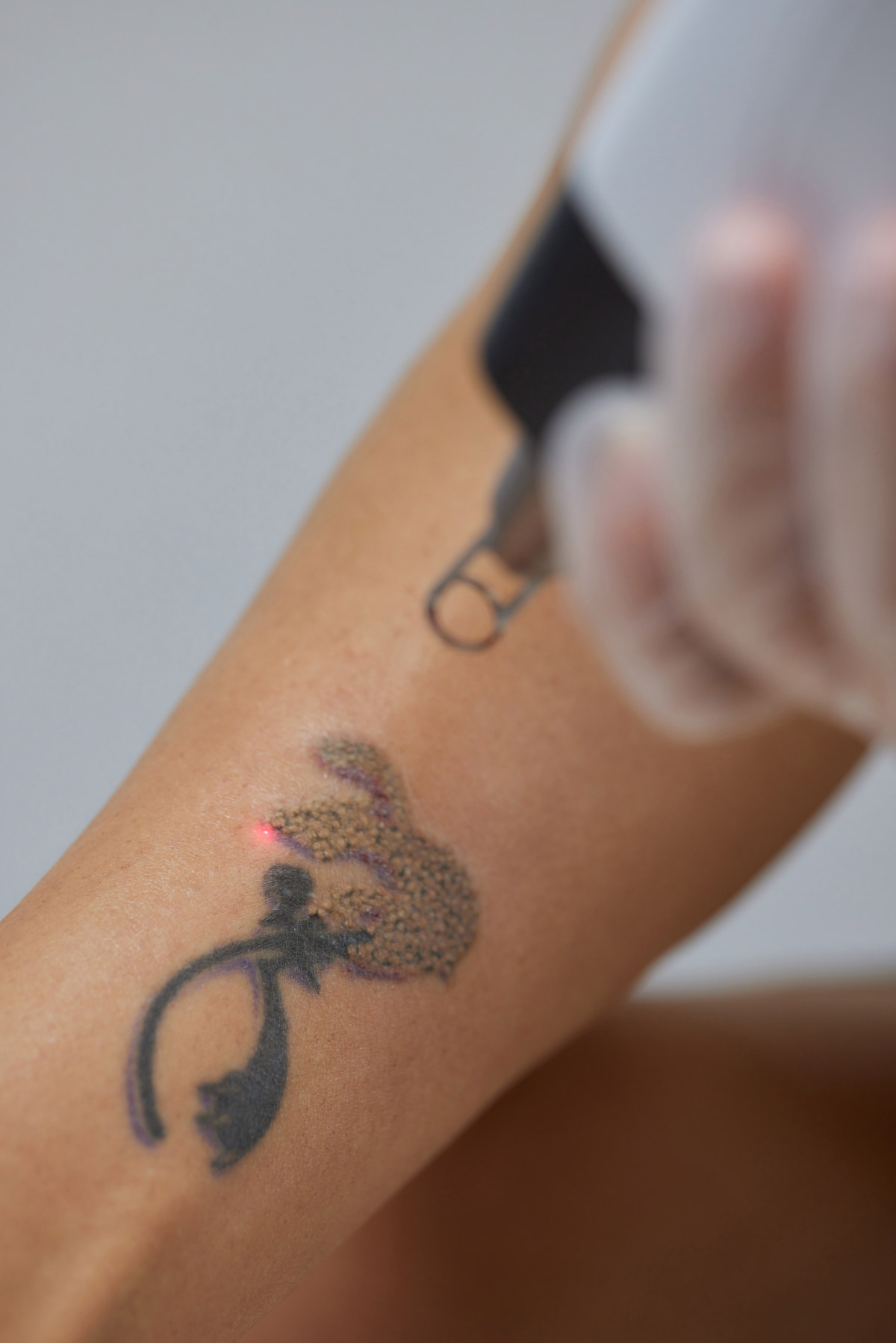 rimozione tatuaggi con laser pico