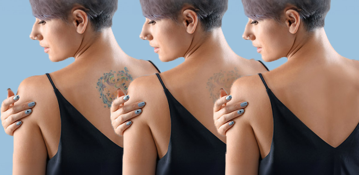 quanto tempo occorre per la rimozione dei tatuaggi