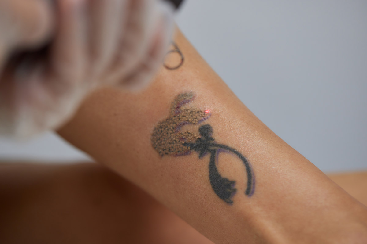 rimozione tatuaggi senza cicatrici